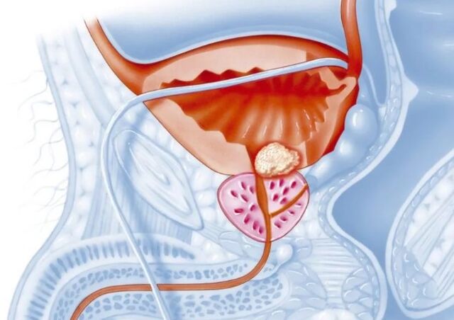 Lėtinės prostatito formos savybės