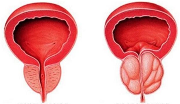 Lėtinis prostatitas