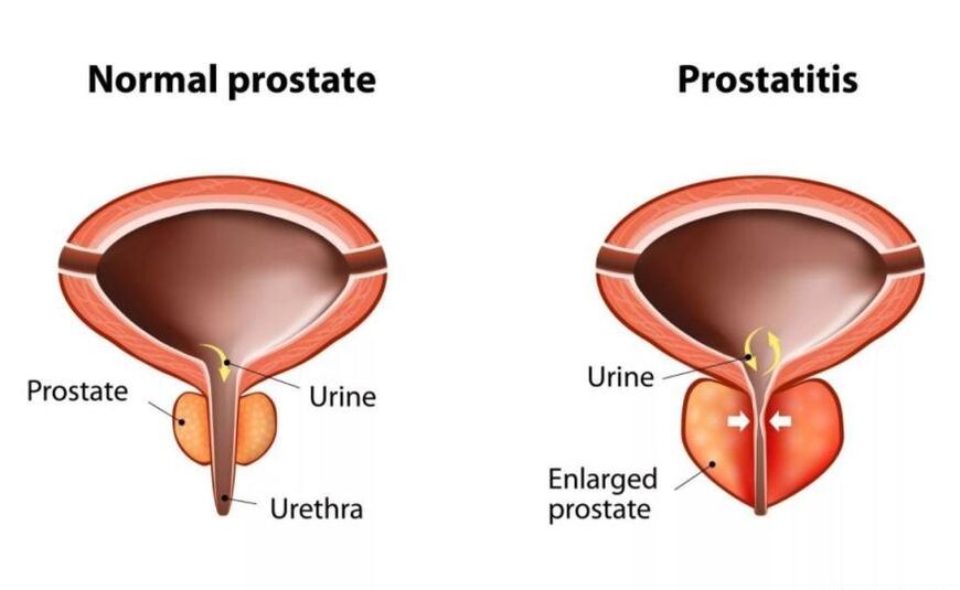 Normali prostata ir uždegta