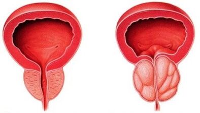 Sveika ir uždegta prostata su prostatitu